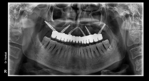 Happy patient with maxillary