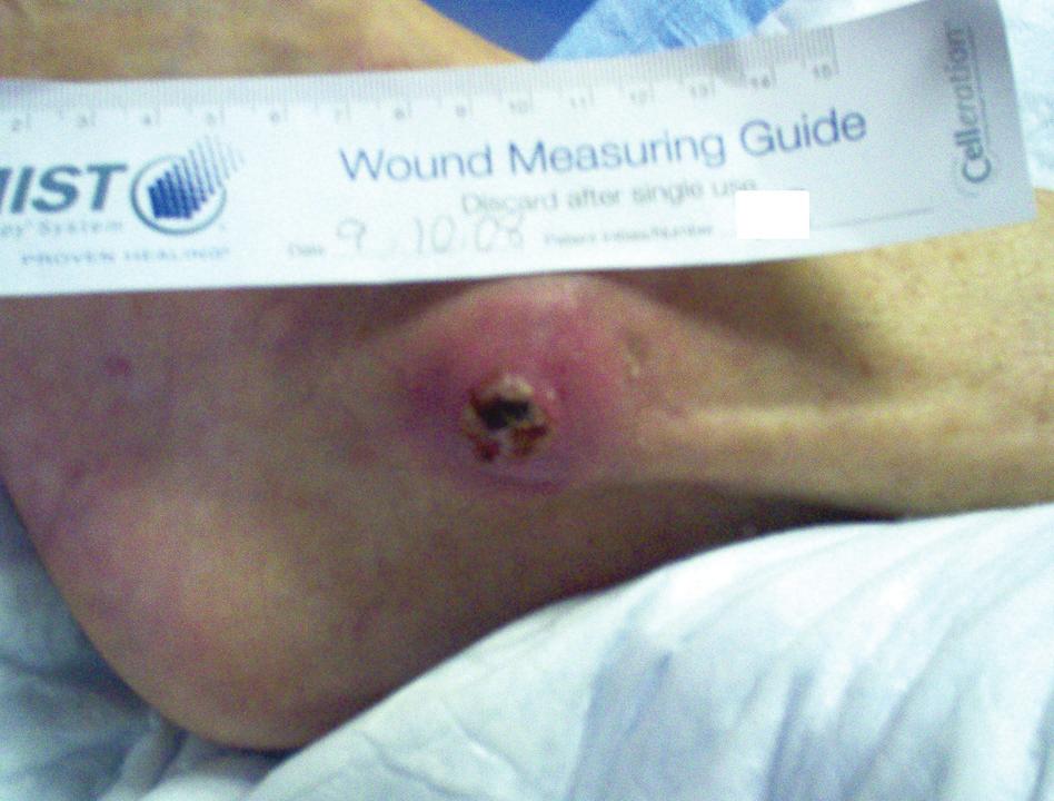 1 The National Pressure Ulcer dvisory Panel (NPUP)1 guidelines for pressure ulcer staging are clear: until enough slough and/or eschar is removed to expose the base of the wound, the true depth, and