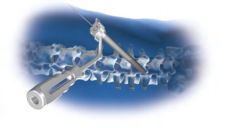 Instrumentation is available for both percutaneous and open approaches with the FIXCET Spinal Facet Screw System.
