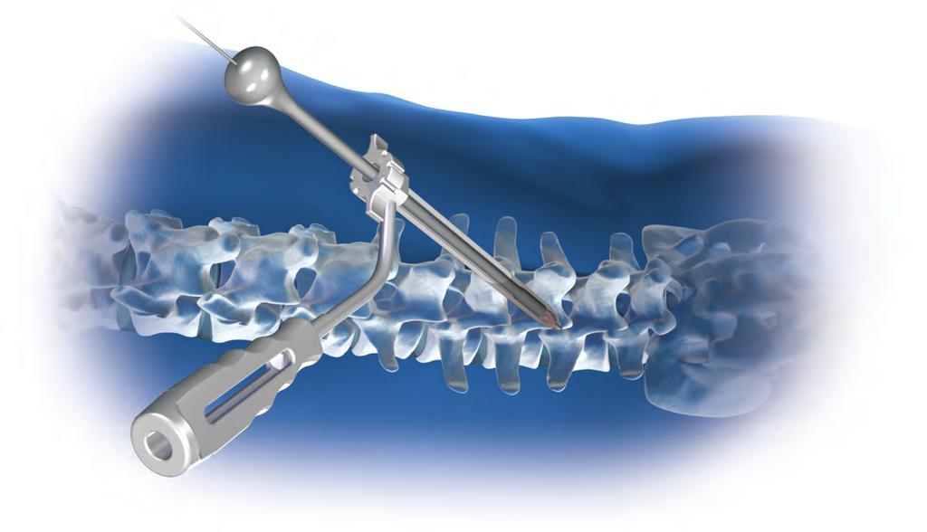 Step 3 Placement of Bone Graft Appropriate arthrodesis and interbody fusion with a load-bearing construct should be performed prior to screw placement.