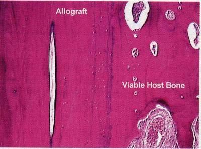 Graft Incorporation Cortical allograft strut graft