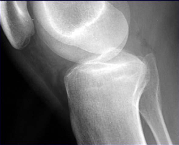 Indications for Bone Graft Provide mechanical support Metaphyseal impaction 27 y.