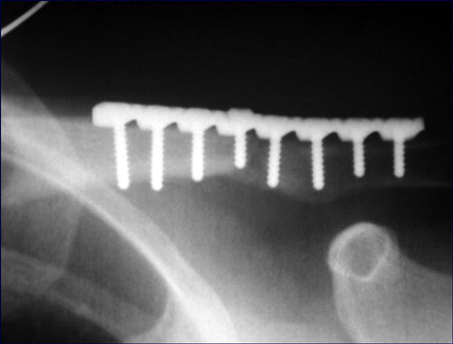 Indications for Bone Graft Provide mechanical support Metaphyseal impaction Replace bone Cortical or segmental