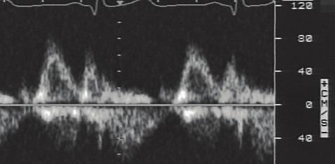 146 Left Ventricular Geometry and Diastolic Function in Hypertension the left ventricular filling pressure, as assessed by the Doppler indices.