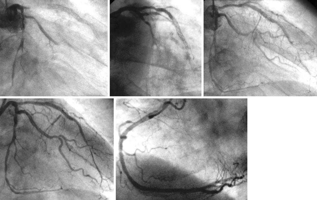 a: Total and subtotal spasm were observed at the proximal left anterior descending artery or proximal left circumflex artery. b: Contrast medium was observed at the proximal left coronary artery.