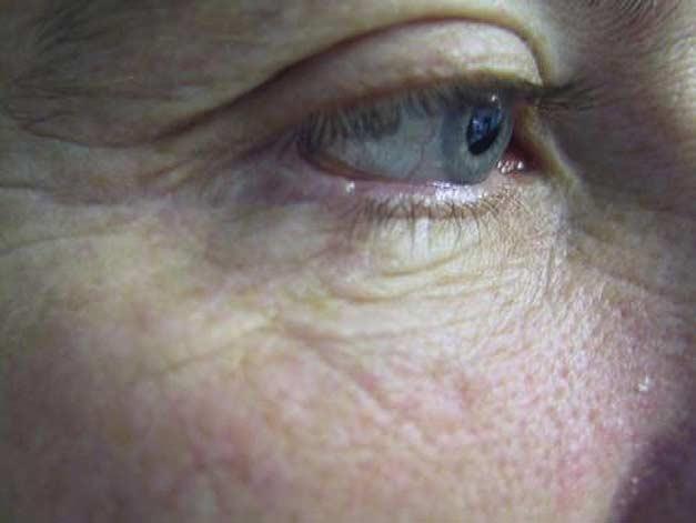 Twenty-two Hübner grafts 363 Figure 5 Keratotic basal cell carcinoma. Results at 2 years with loss of lashes. upper eyelid and twelve from the contralateral lower eyelid.