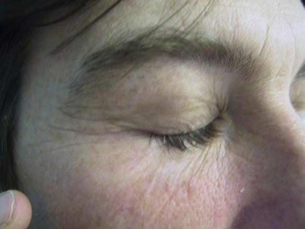 The 13 patients were asked to assess the cosmetic results of their reconstructed eyelids. Nine patients rated the final result as very good, two as good, one as fair, and one as poor. Figs.