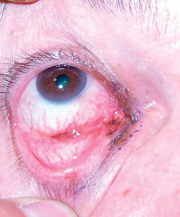 The 21 mm defect in the right lower eyelid had been closed with a 10 mm tarsomarginal graft harvested from the contralateral lower eyelid and a mini rotation cheek flap.