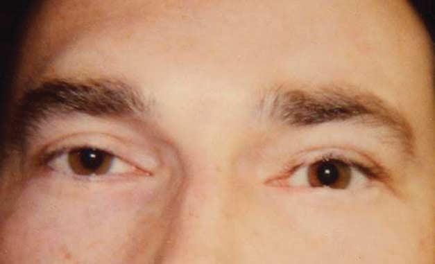 eyelid and of the medial third of the lower eyelid of the right eye.