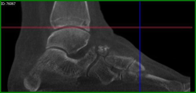 PedCat CBCT Findings: (Figures 3, 4 & 5) The sagittal, transverse, and frontal plane reconstruction views demonstrate a narrow and irregular gap between the anterolateral process of the calcaneus and
