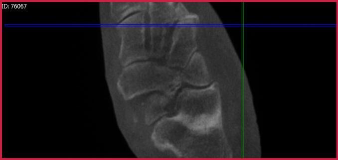 Case I (Figure 5): PedCat CBCT transverse plane reconstruction demonstrating calcaneo-navicular and cuboid-navicular coalitions.