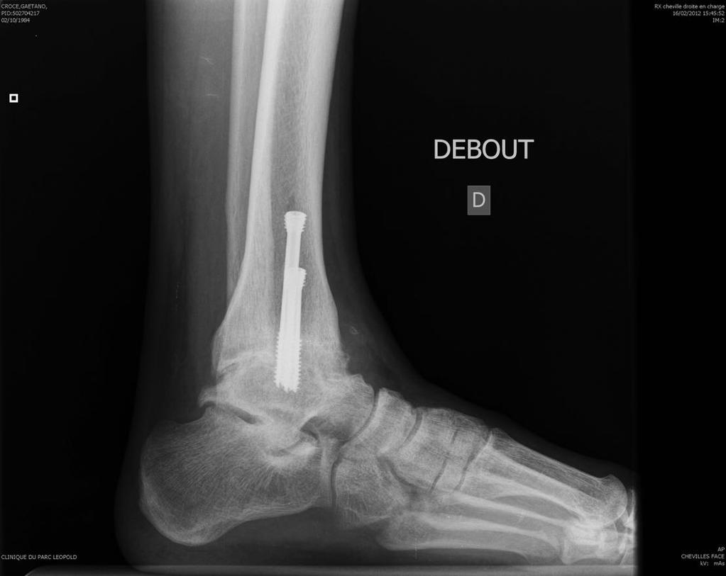lateral radiograph of the foot and