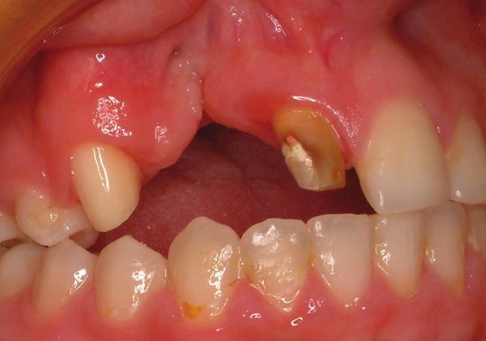 This requires preparing at least one tooth on each side of the edentulous space and placing complete or partial metal-ceramic restorations [9].