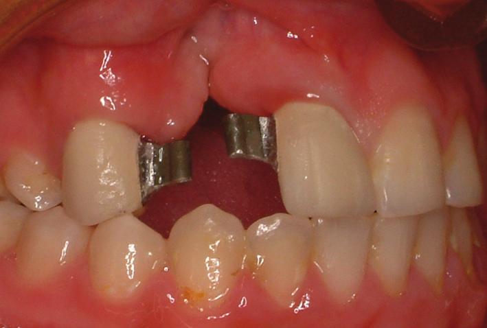 However, a removable partial denture with/without extra or intracoronal attachment can also be used in prosthetic treatment, if lip support is increased due to poor bone quality [10].