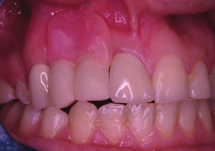 Case Reports We treated a 19-year-old woman and a 21-year-old woman with surgically treated UCLP in the Department of Prosthodontics, Dicle University.
