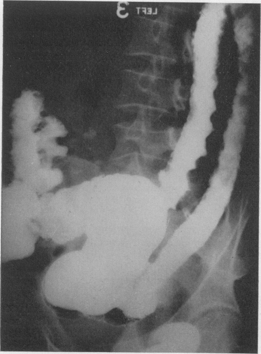 For example, the ten cases described as 'mixed forms' in their series, and classified with colitis, would probably now be described as Crohn's disease of the colon.
