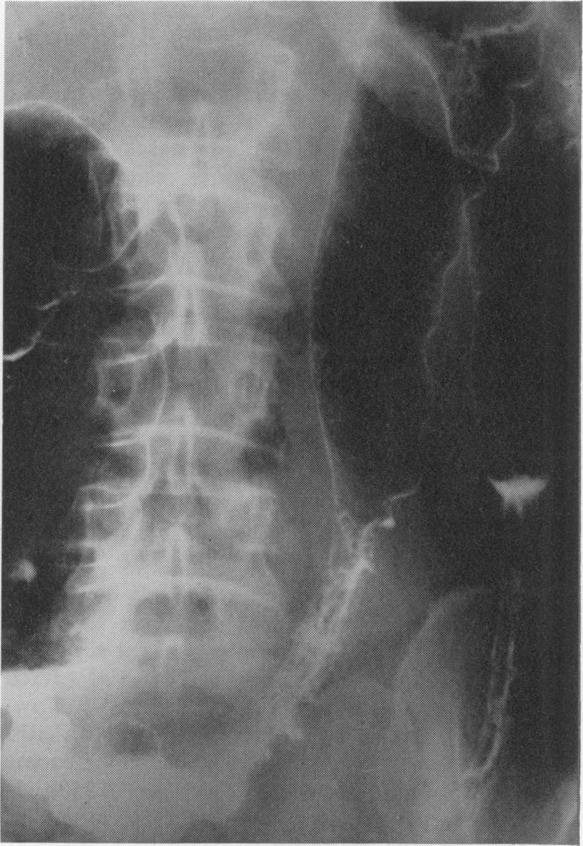 3) showed marked changes in the transverse and descending colon. Proctocolectomy was performed. The patient was well when last seen 4 years later.