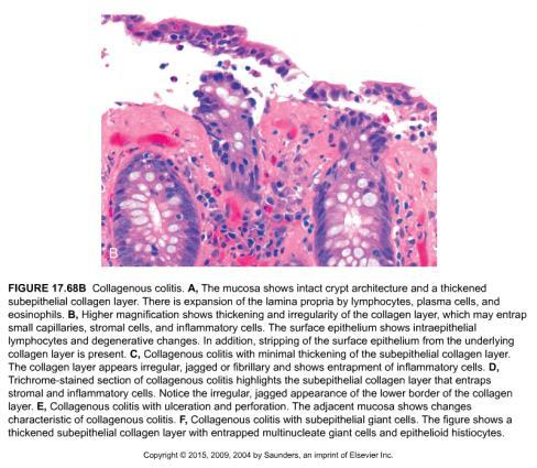 lymphocytes Rarely collagen seen in ileum and elsewhere in GI tract Collagen layer >10