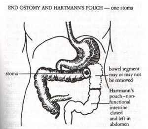 Brainerd diarrhea Crohn s disease, CVID, immune diseases, drugs, IBS Paucicellular