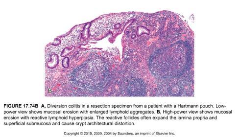 Diversion colitis: mucosal erosion, reactive lymphoid