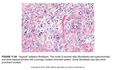 Radiation colitis: atypical fibroblasts May be associated with focal active colitis/ileitis or ulcers throughout the colon Abrupt ulcers with no significant inflammation in the