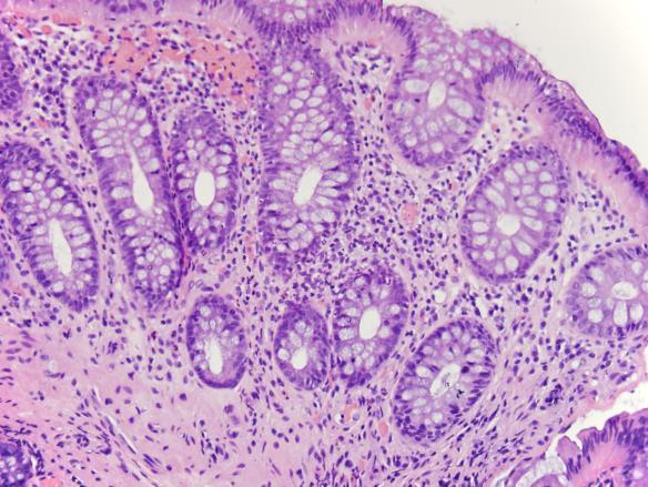 Few persistent foci of cryptitis (focal active colitis) Small granulomas, usually secondary to crypt rupture Patchy lamina propria inflammation with increased lymphocytes, neutrophils, eosinophils,