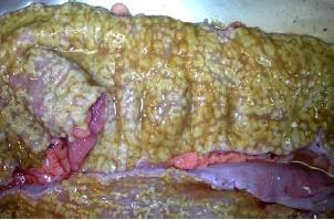Usually normal endoscopy In adults interpret conservatively Focal active colitis is