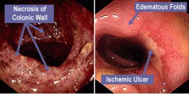 Geographic areas of ulceration with pseudomembranes Endoscopically marked submucosal edema can be prominent enough to mimic a tumor or