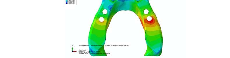 von Mises Stress Distribution in Cortical Bone A) Model I: In the left posterior implant stress is extensive in crestal bone of the distal aspect of implant. The maximum von Mises stress is 51.
