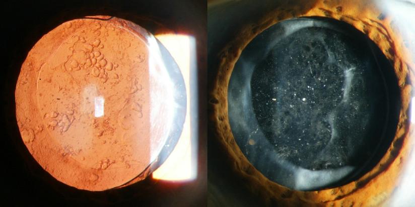 Technical Considerations Conventional YAG lasers are designed for posterior capsulotomy and iridotomy treatments: Limited view of the vitreous,