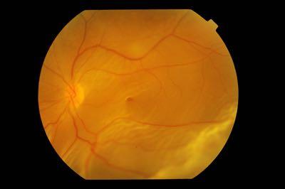 Infection Retinal Detachment Macular Edema Sendrowski DP,
