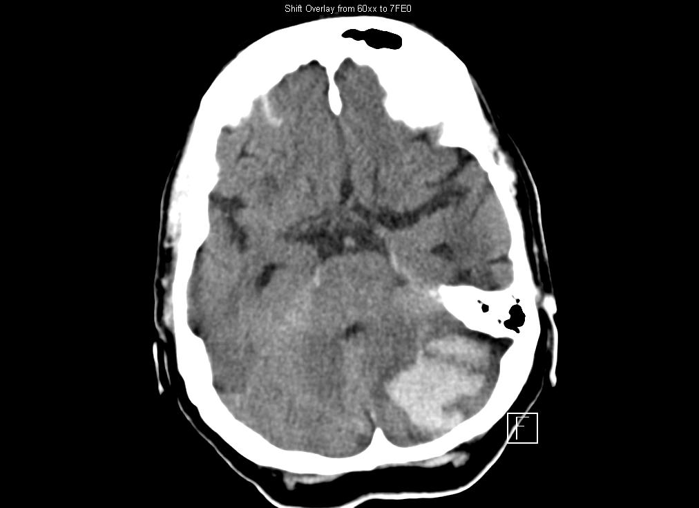 Intracranial Hemorrhage: Efficacy at the Cost of Safety Study ICOPER (Goldhaber SZ, et al.
