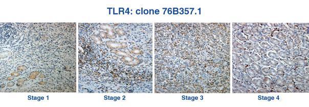 TLRs in Cancer Tumor cells and the microenvironment Gastric carcinoma, 4 patients: TLR4 (NB100-56566) expression in gastric epithelial tumor cells