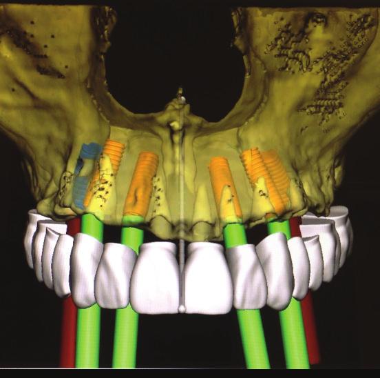 IMPLEMENT 3D IMPLANT DENTISTRY MONDAY MORNING!