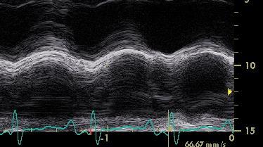 longitudinal fibres Low TAPSE Correlates with RV systolic