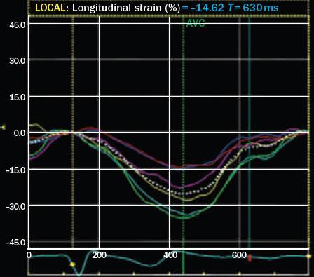 Echo - 2D longitudinal strain Percentage change in