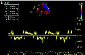 Echocardiographic Assessment of