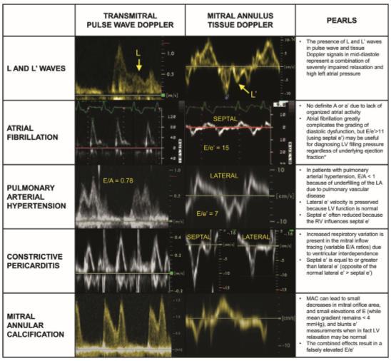 Special Scenarios for Assessing Diastolic Function and LV Filling Pressures Severe impaired relaxation high LA pressure E/e