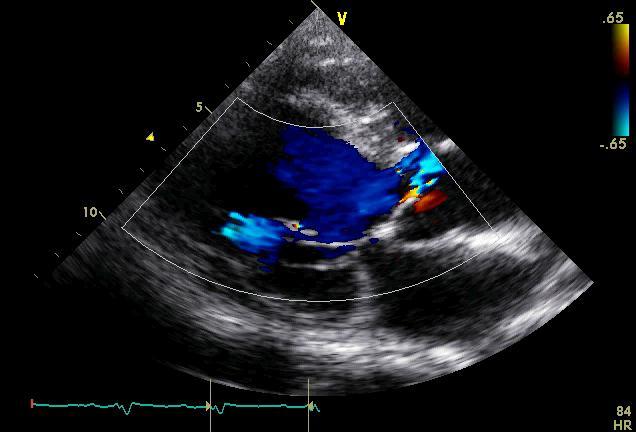 Aortic Regurgitation Increased total SV ejected by the LV The