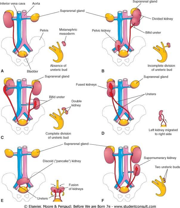 Duplication of upper urinary tract (renal pelvis or ureter) Division of uretric bud Renal agenesis 1/1000 Absence of uretric bud Abnormal rotation Hilum faces