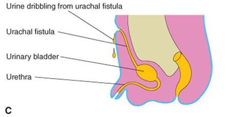 Posterior wall of bladder is