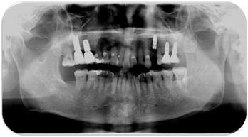 In those cases, prosthetic rehabilitation was initiated 3-4 months after healing period. All cases were restored with cemented single porcelain-fused to metal crowns. Figure 1.