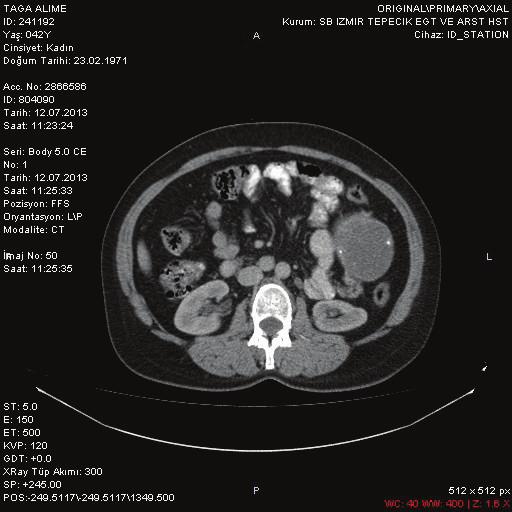 invading the splenic hilum without any pathology of the intraabdominal organs (Figure 1). The patient underwent a laparotomy with a median superior and left subcostal incision.
