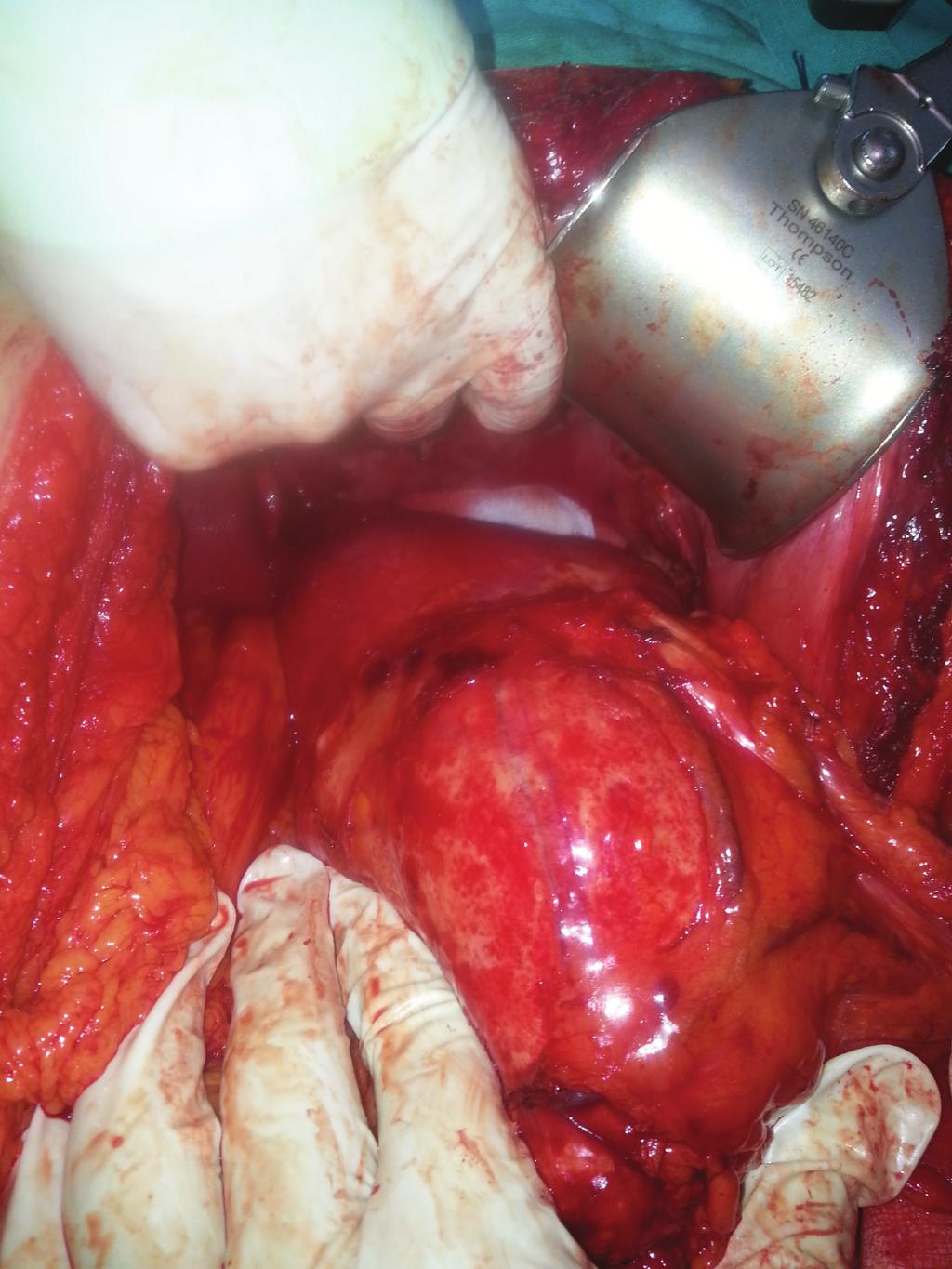 Case Reports in Surgery Figure 2: A large cystic mass that is attached to the left liver lobe (yellow arrow shows the left liver lobe and blue arrow shows the cystic mass).