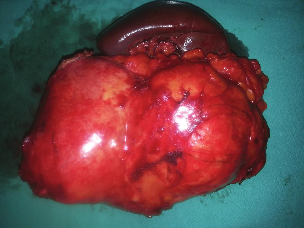 soft tissue tumors, retroperitoneal abscess, cystic lymphangioma, embryonal cyst, ovarian neoplasms, teratoma, and other cystic and necrotic solid tumors [1, 4, 6].
