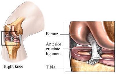 The ACL (Anterior Cruciate Ligament) is the major stabilizing ligament of the knee. The ACL is located in the center of the knee joint and runs from the femur (thigh bone) to the tibia (shin bone).