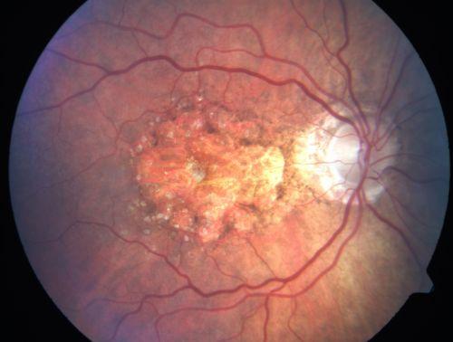 AGE-RELATED MACULAR DEGENERATION AGE-RELATED MACULAR DEGENERATION Threats to