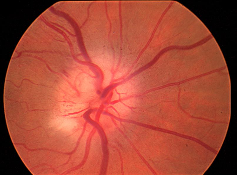OPTIC NEURITIS OPTIC NEURITIS TREATMENT TRIAL (ONTT) Inflammation of optic nerve Patients randomized into 3 groups Consider in younger patients (20-40) Oral pred (1 mg/kg/day) x 14 days IV steroid x