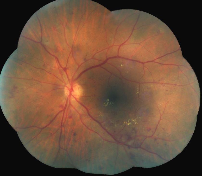 25 26 EARLY TREATMENT DIABETIC RETINOPATHY STUDY (ETDRS) Found benefit if Clinically Significant Macular Edema (CSME)