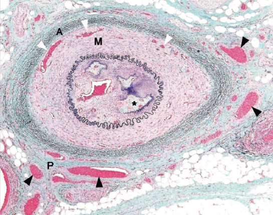 Histologic Sections from Patients with CLI